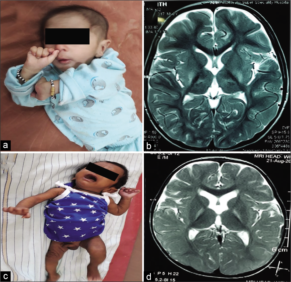 (a and b) Child with dyskinetic cerebral palsy with magnetic resonance imaging (MRI) (b) brain T2 axial showing hyperintensities in bilateral posterior putamen and thalami suggestive of acute hypoxic insult. (c and d): Child with dyskinetic cerebral palsy with dystonic posturing and arching of neck due to dystonia and MRI brain (d) T2 axial showing bilateral symmetrical hyperintensities in globus pallidus due to bilirubin-induced neurologic dysfunction.
