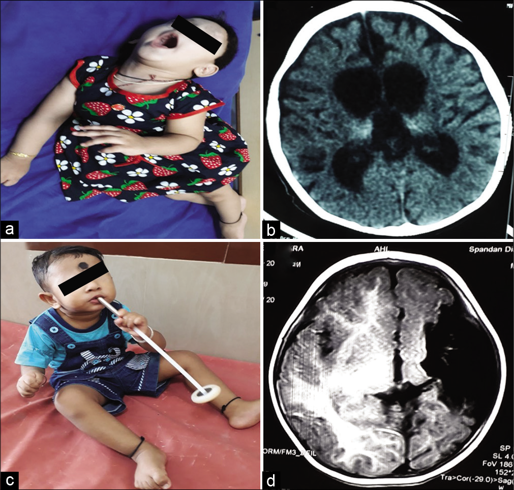 (a and b) Child with dystonic cerebral palsy with severe arching of back and neck due to dystonia and computed tomography (b) brain showing bilateral thalamic calcifications with cerebral atrophy with enlarged ventricles suggestive of hypoxic insult. (c and d): Child with hemiplegic cerebral palsy with magnetic resonance imaging (d) of brain showing porencephalic cyst.