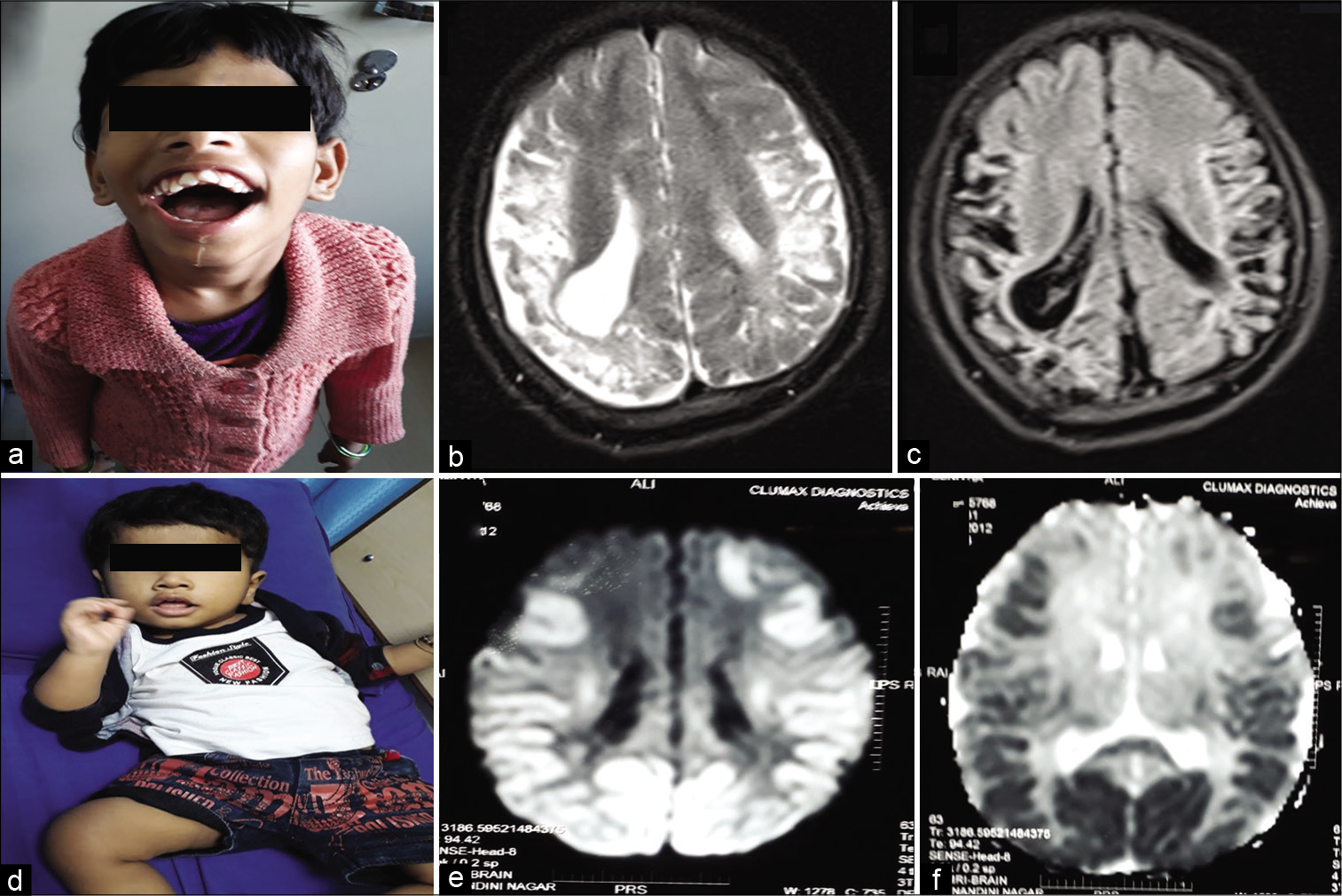 (a-c) Perisylvian syndrome – type of cerebral palsy showing drooling, magnetic resonance imaging (MRI) of brain (b and c) showing gliosis in the perisylvian region. (d-f): Neonatal hypoglycemic brain injury: Clinical photo (d) showing strabismus and MRI of brain: DWI (e) and ADC (f) showing restricted diffusion and low ADC in the bilateral parieto-occipital region.