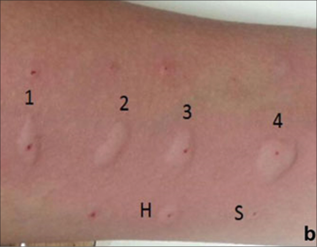 Picture showing wheal and flare reaction after a skin prick testing using histamine (h), saline (s), and various allergens (marked 1–4). Reproduced with permission from Gupta N, Indian pediatrics 2019.