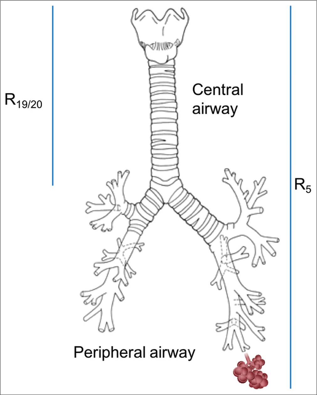 Impulses of various frequencies traveling through airway. Smaller frequency sound waves (5 Hz), being more energetic, travel till the farthest point of respiratory system, that is, alveoli. Higher frequency (20 Hz) remains in the central airways depicting the characteristic of respective part.