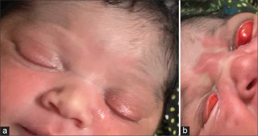 (a) Clinical photograph of a neonate showing overlapping of upper eyelids on lower eyelids on eye closure (left>right). (b) Clinical photograph showing spontaneous eversion of both upper eyelids while crying and tarsal conjunctival hyperemia.