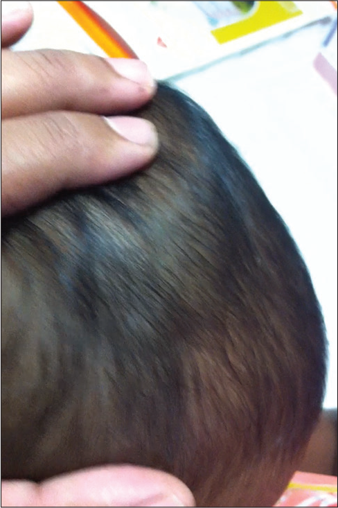 Scalp swelling in Case 1.