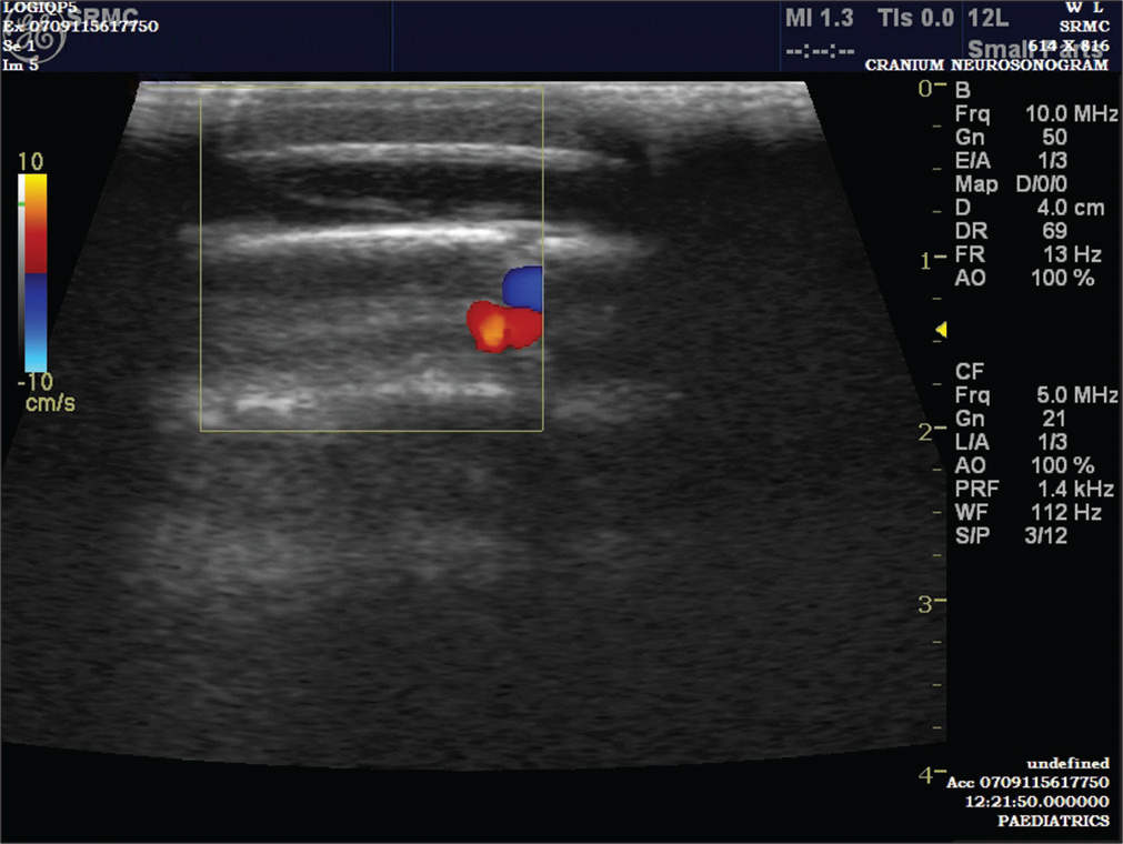 Ultrasound sonography showing subaponeurotic fluid collection in case 1.
