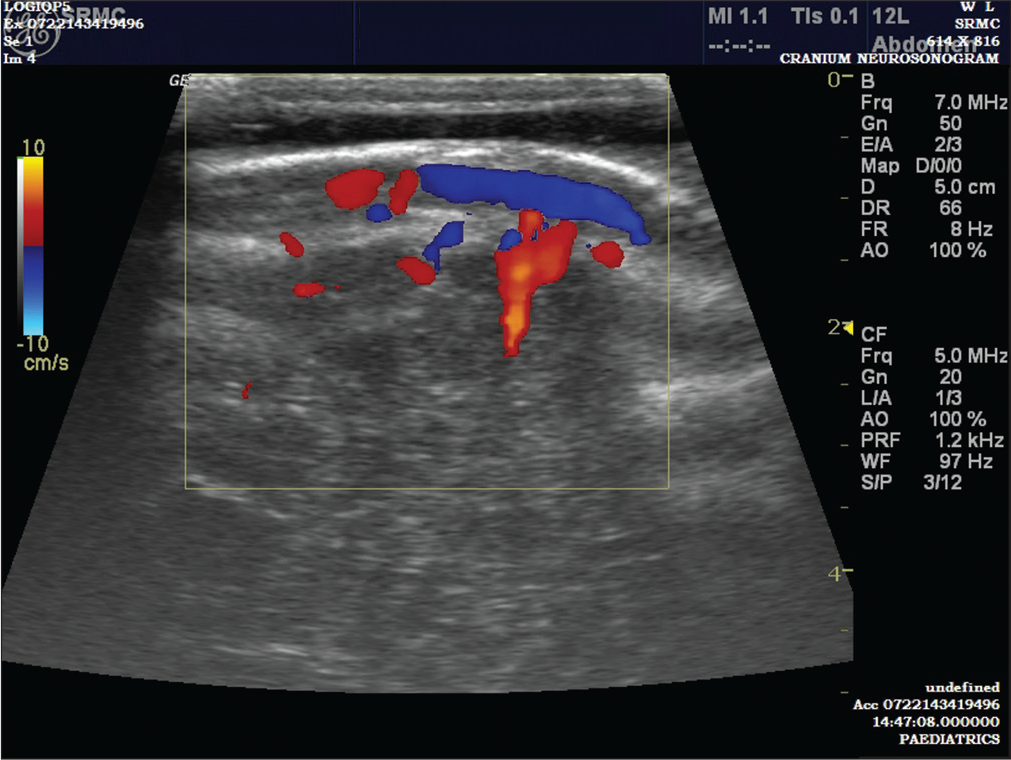 Ultrasound Sonography showing subaponeurotic fluid collection in case 2.