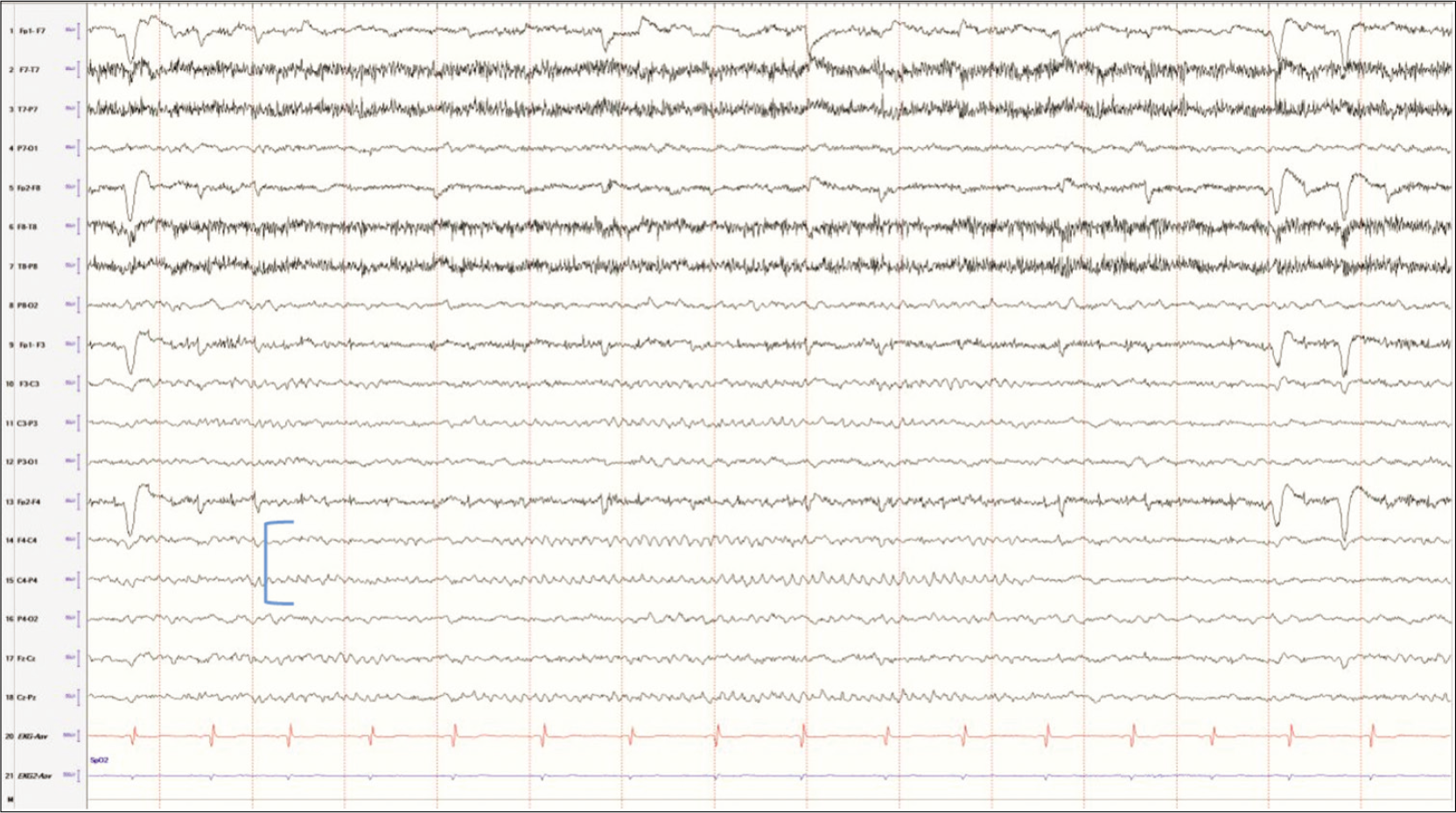 Mu rhythm in a developmentally normal 9-year female.