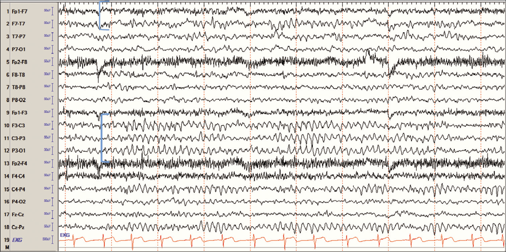 Asymmetry due to skull defect (breach rhythm) in the left central region in an 11-year-old girl with a history of epilepsy surgery. Note the slowing in the left temporal chains indicating cortical dysfunction – in this case, the resection.