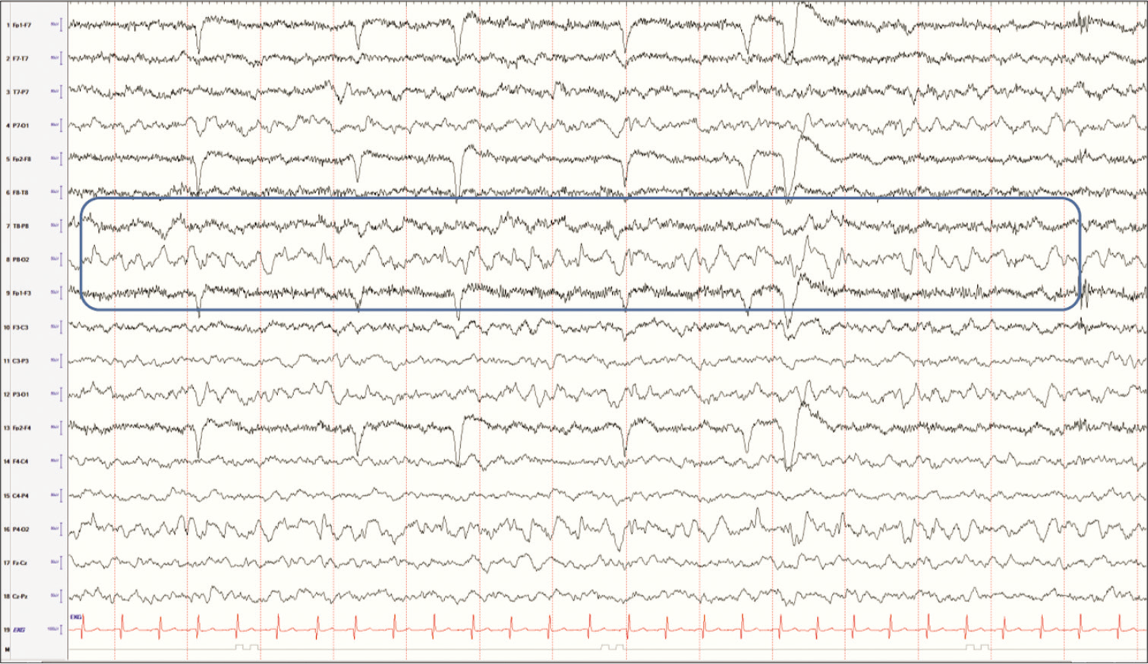 Posteriorly located biphasic sharp waves in an awake child scanning a complex picture consistent with lambda waves.