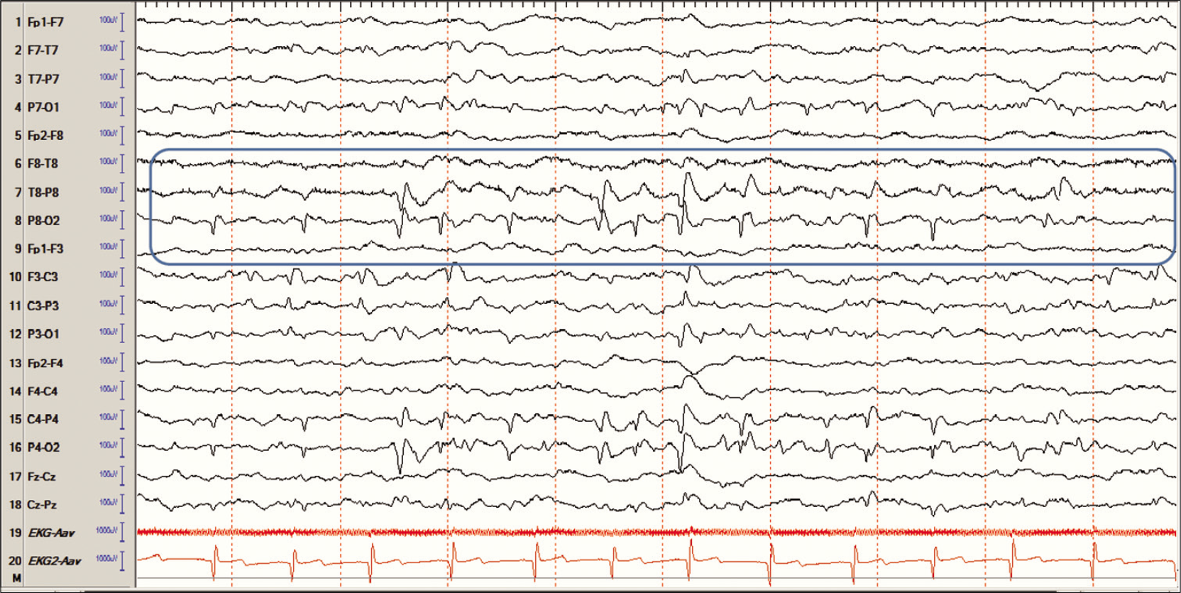 Occipital spikes with a prominent negative component and a field extending anteriorly in a child who is sleeping. Compare the morphology and the state of the patient with lambda waves.