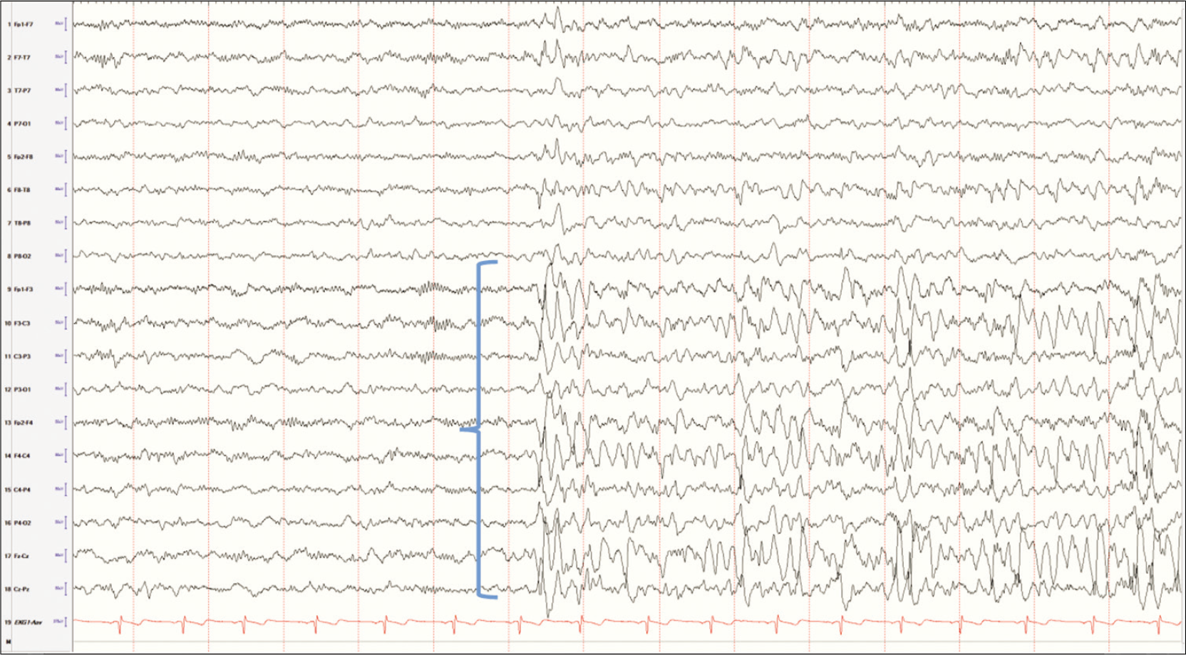 Vertex limited to the parasagittal electrodes in early stages of sleep in a young child.