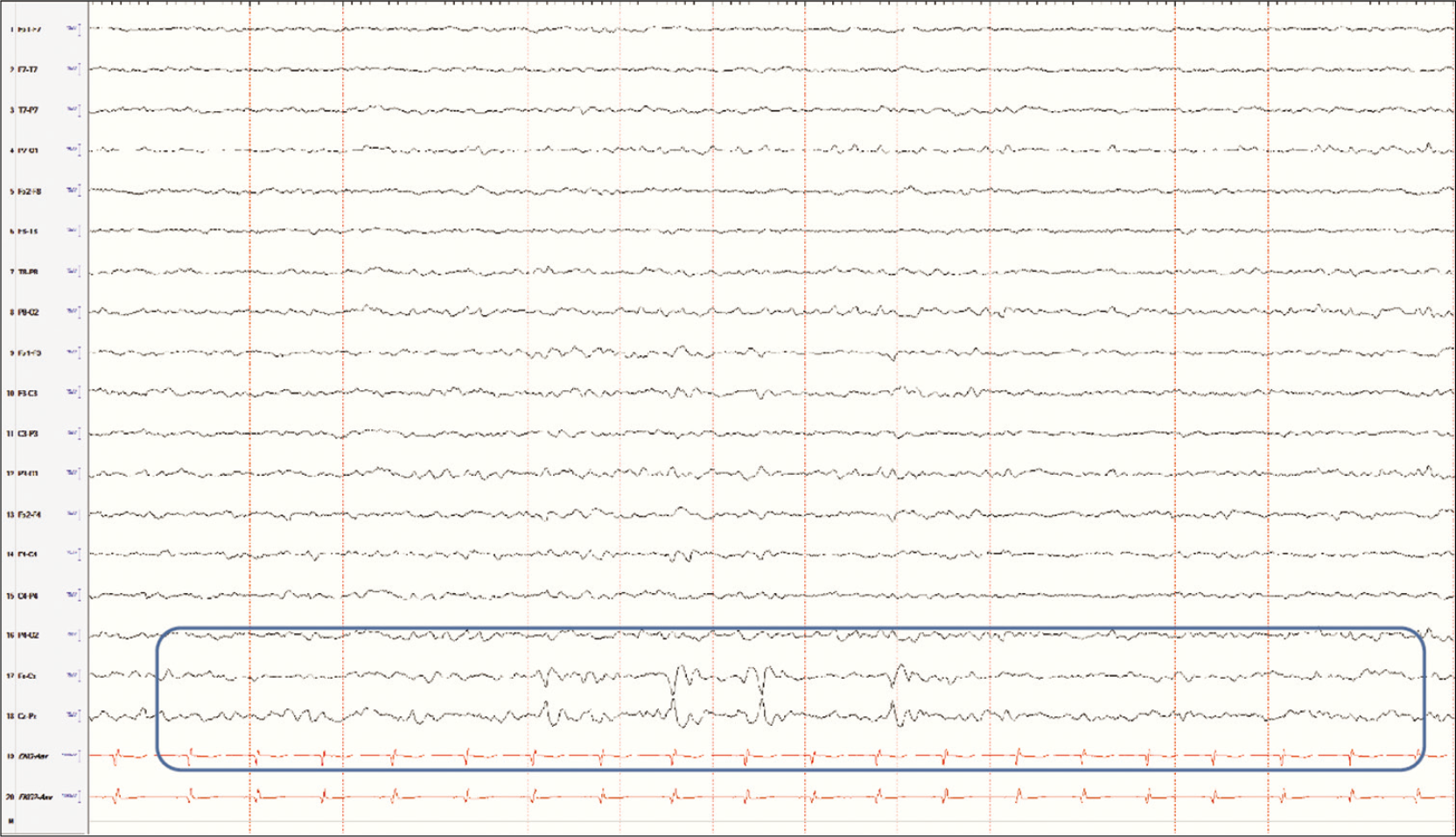 Vertex waves limited to the Cz electrode in sleep.