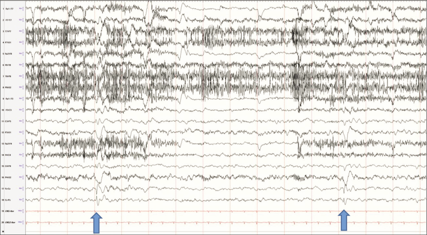 Spikes in the vertex electrodes, maximum in Cz (arrows). Note the difference between these waves and the vertex waves. These are present while the patient is awake, which vertex waves would not be seen in wakefulness.