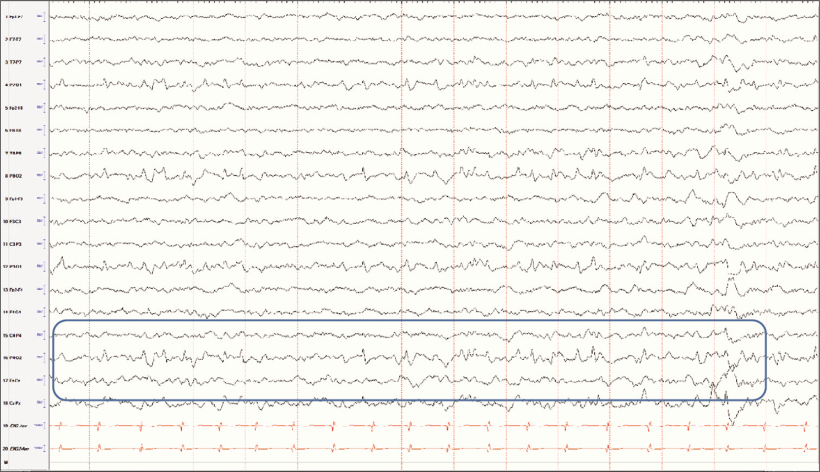 POSTS seen in a child with no history of epilepsy in sleep. The morphology of these waveforms resemble those of another benign variant, the lambda waves and is not to be confused with occipital spikes.