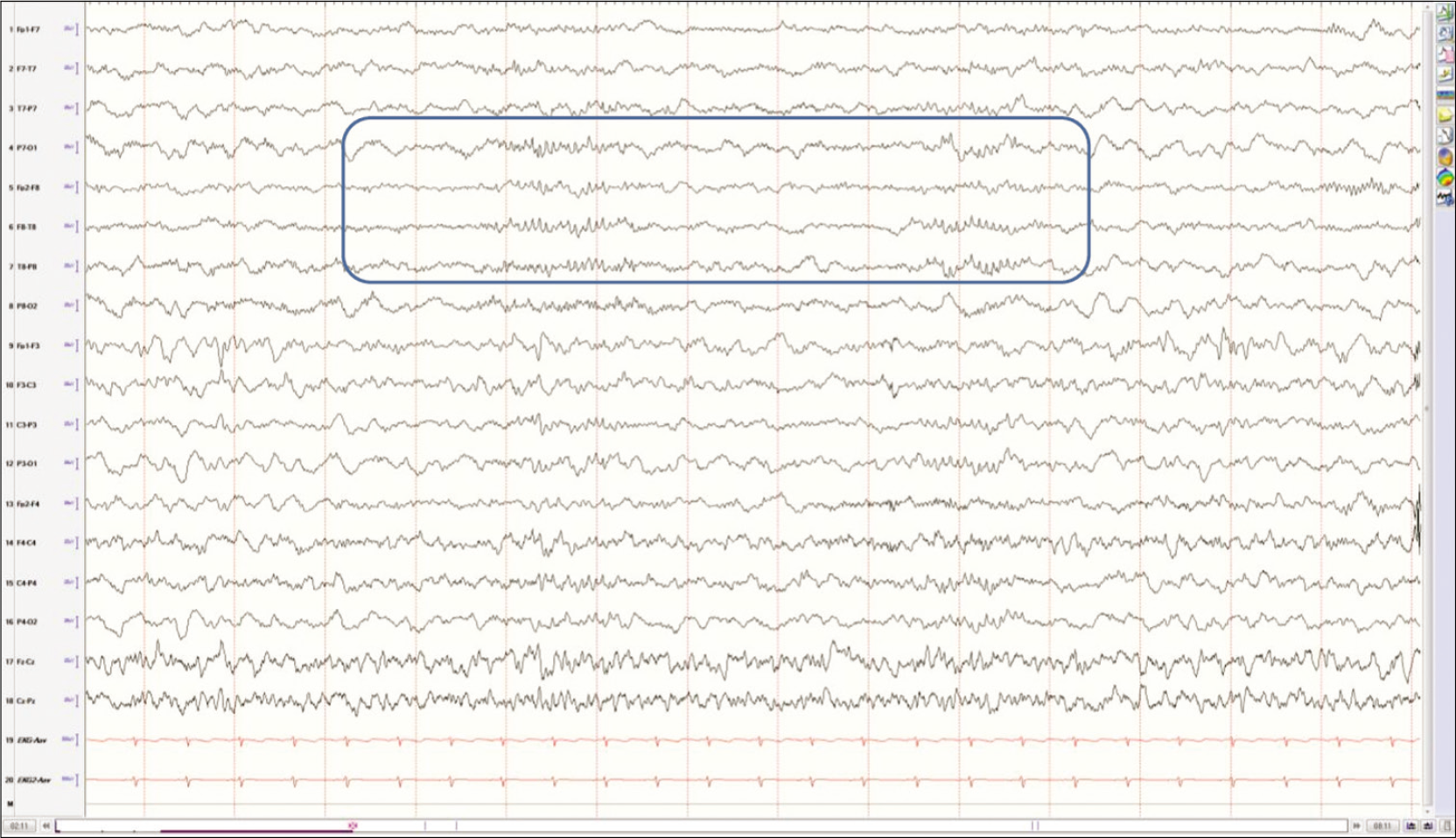 Fourteen and six positive bursts in an 8-year-old boy in light sleep stages. The bursts are seen in both hemispheres and last about 1 s in duration.