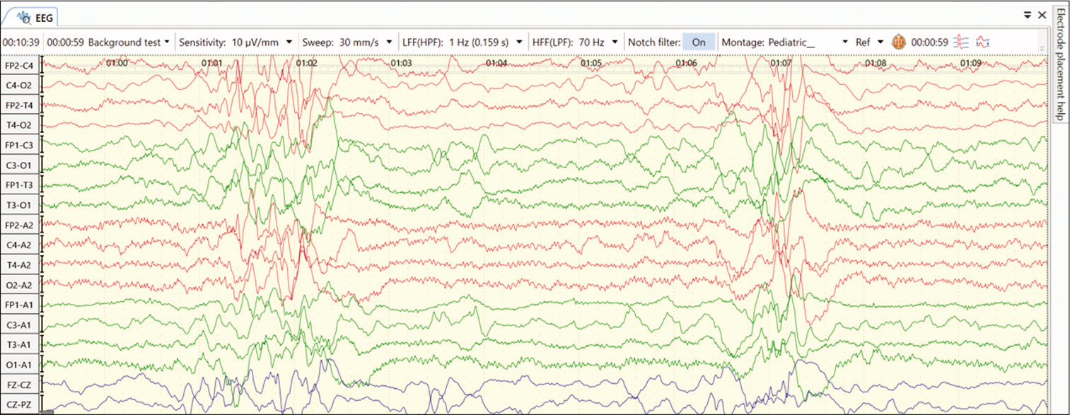 EEG abnormality with features like hypsarrhythmia in an infant with biotinidase deficiency.