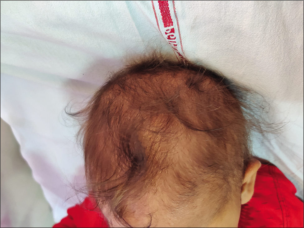 Sparse hair in a child with nutritional Vitamin B-12 deficiency (infantile tremor syndrome).