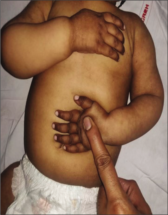 Hyperpigmentation in a child with infantile tremor syndrome, note the pigmentation on dorsum of hands and reticular pigmentation of arms and forearms.