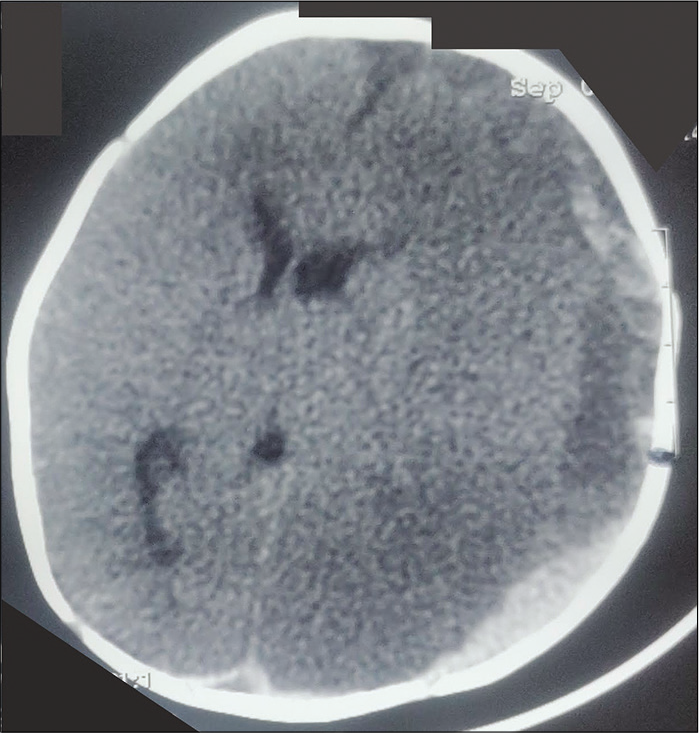 Plain CT head in an infant with Vitamin K deficiency, large subdural bleed on the left side (black arrow, note the separation of serum and clot giving two density appearances of the bleed), with secondary ischemic changes and midline shift. The baby had presented with pallor, coma, and bulging non-pulsatile anterior fontanelle.