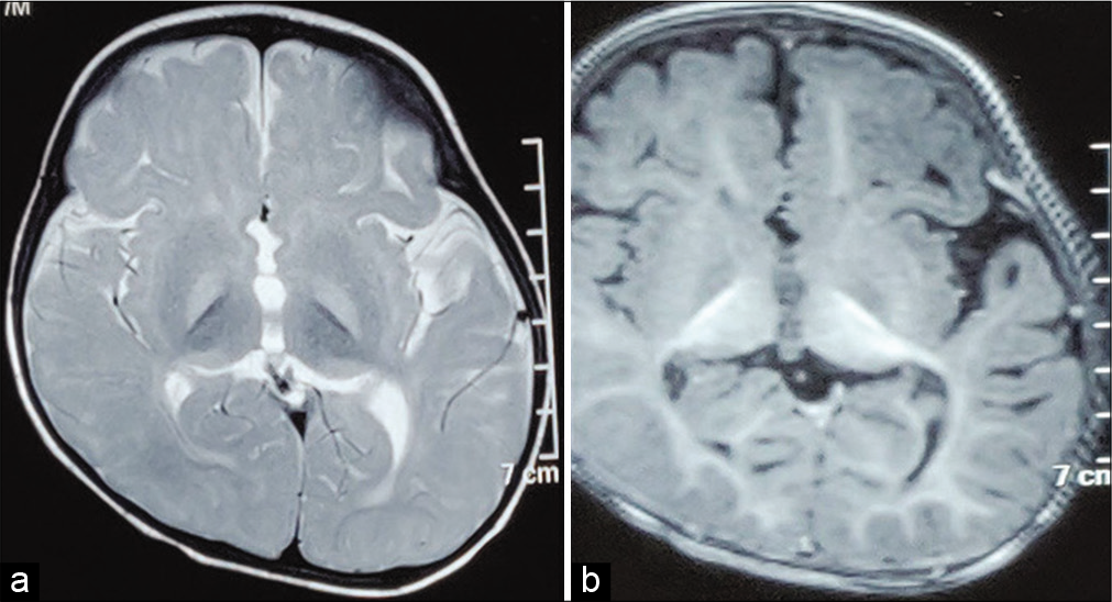 Neuroimaging of the index child. (a) T2-weighted image showing bilateral symmetrical globus pallidus hyperintensity (b) T1-weighted image showing bilateral globus pallidus hypointensity.