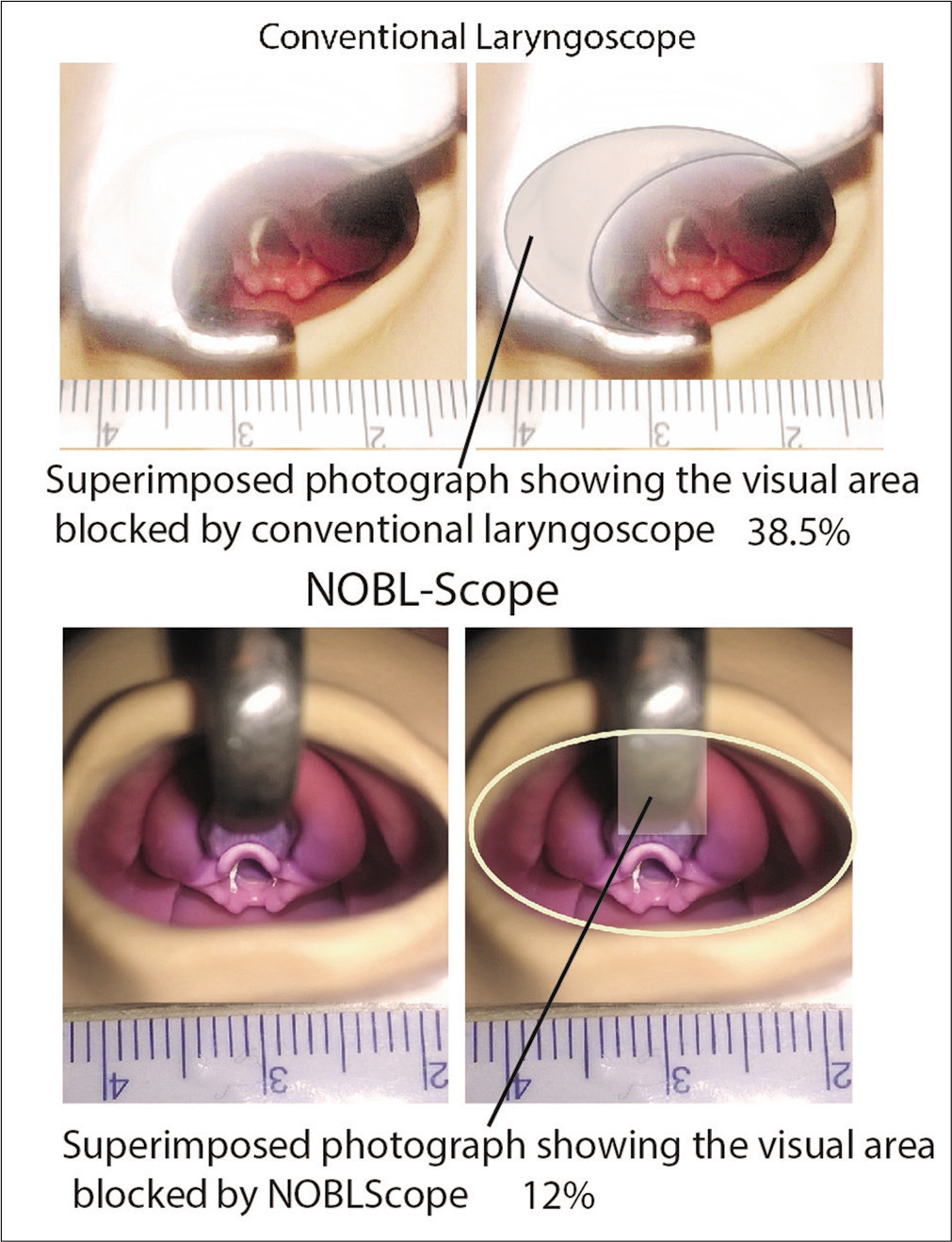 Comparison of vision blocked by conventional pediatric laryngoscope and NOBL scope.