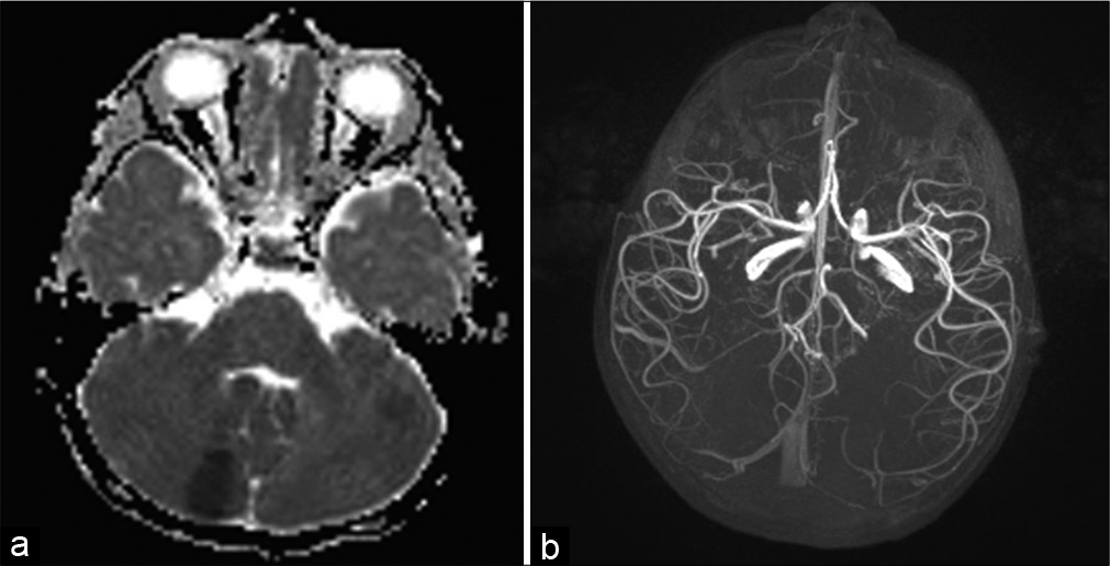 (a) Focal areas of restricted diffusion in midbrain and left cerebellum. (b) Normal arterial circulation.