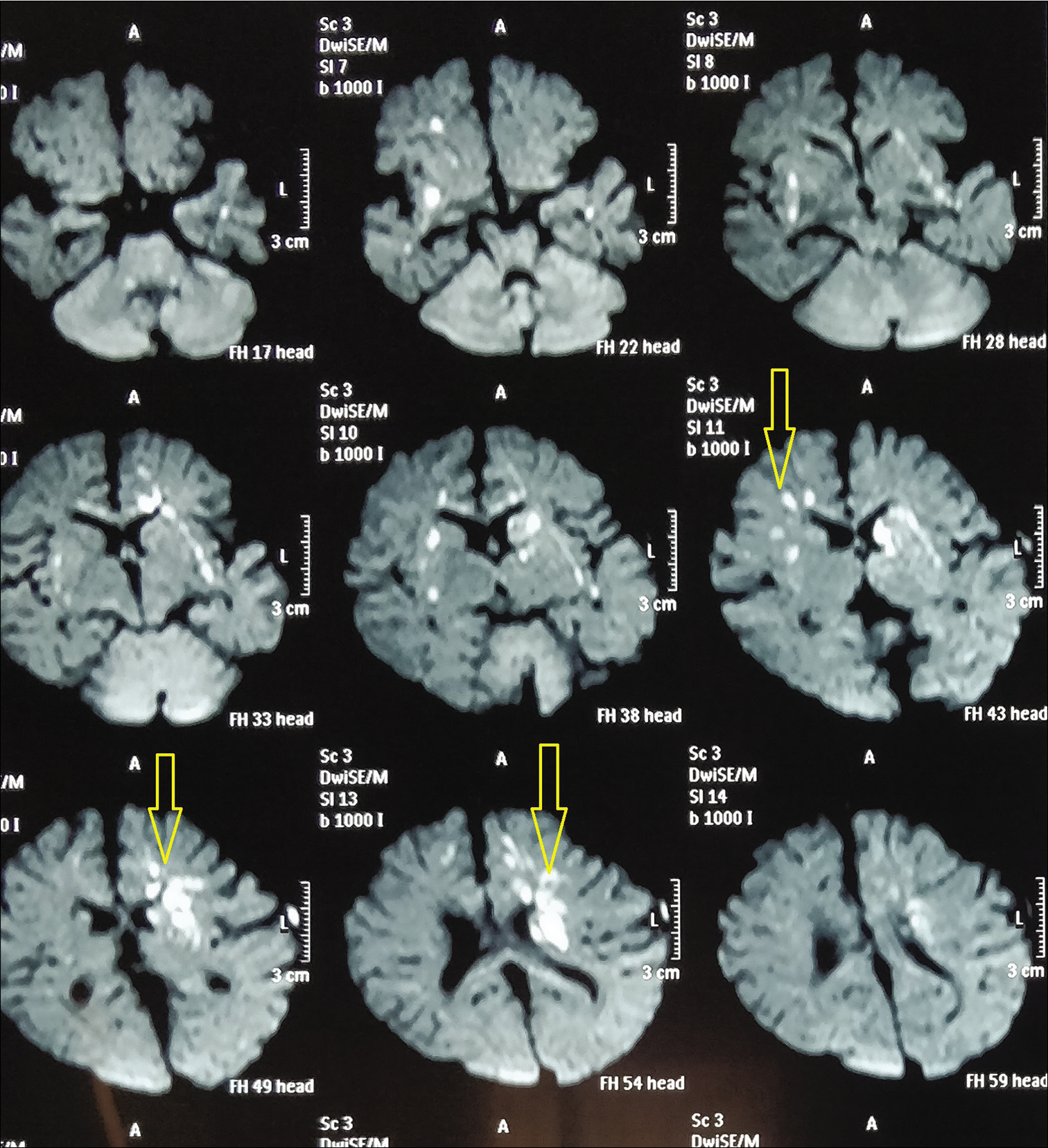 Acute infarcts in bilateral cerebral hemispheres.