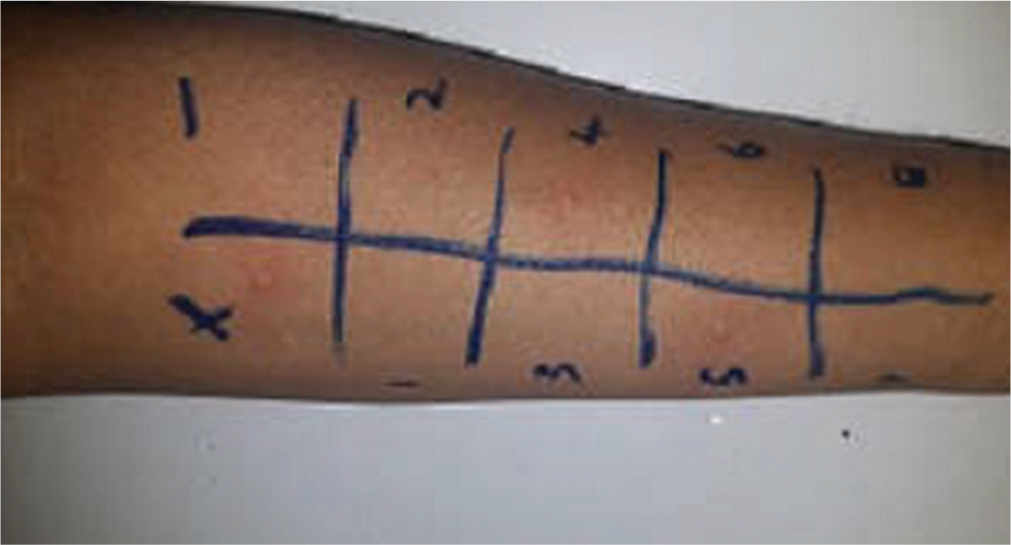 Allergy skin prick test for aeroallergens with histamine and saline controls.