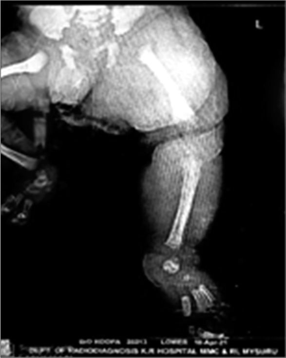 X-ray findings - soft tissue hypertrophy.