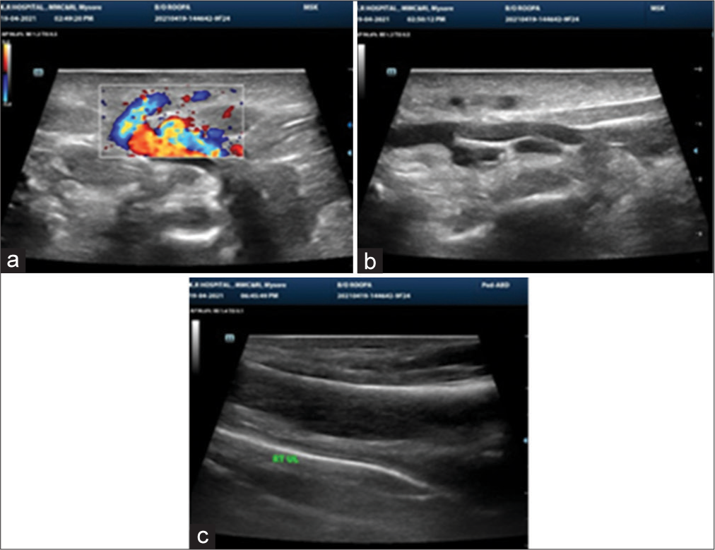 (a-c) USG thigh and calf showing bulky soft tissues with loss of fibrillar pattern.