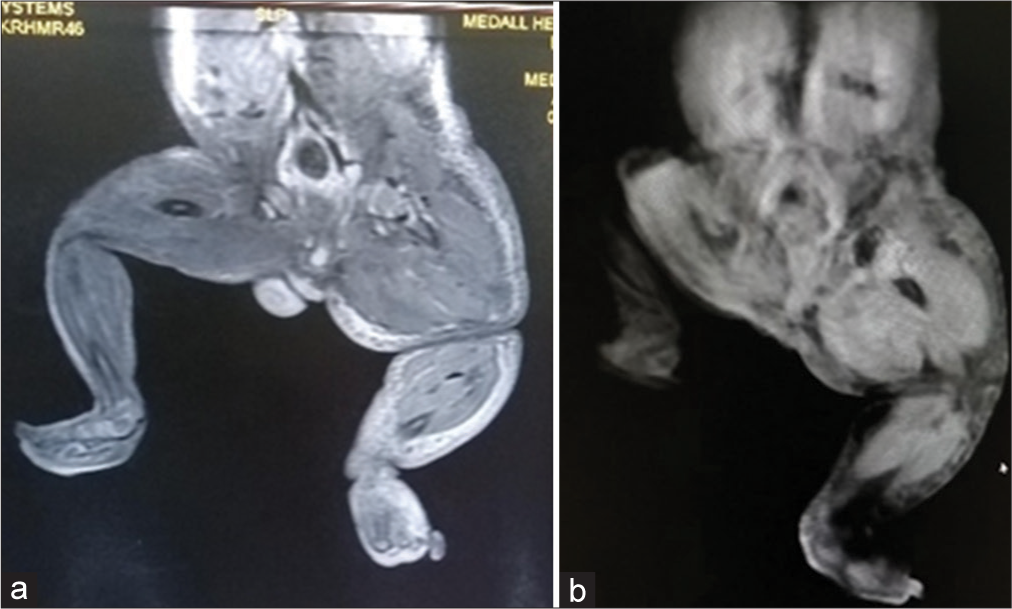 (a and b) MRI showing soft tissue hypertrophy of the left lower limb.