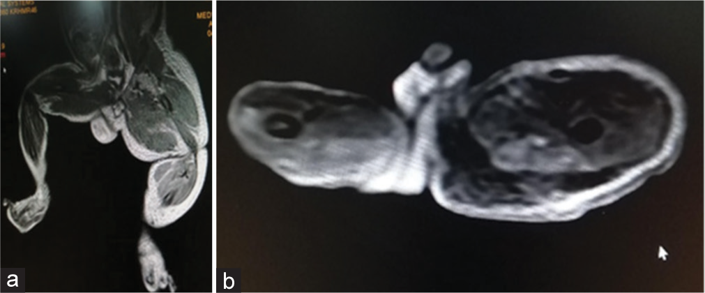 (a and b) - MRI showing dilated superficial venous system with prominant arterial system of the left lower limb.