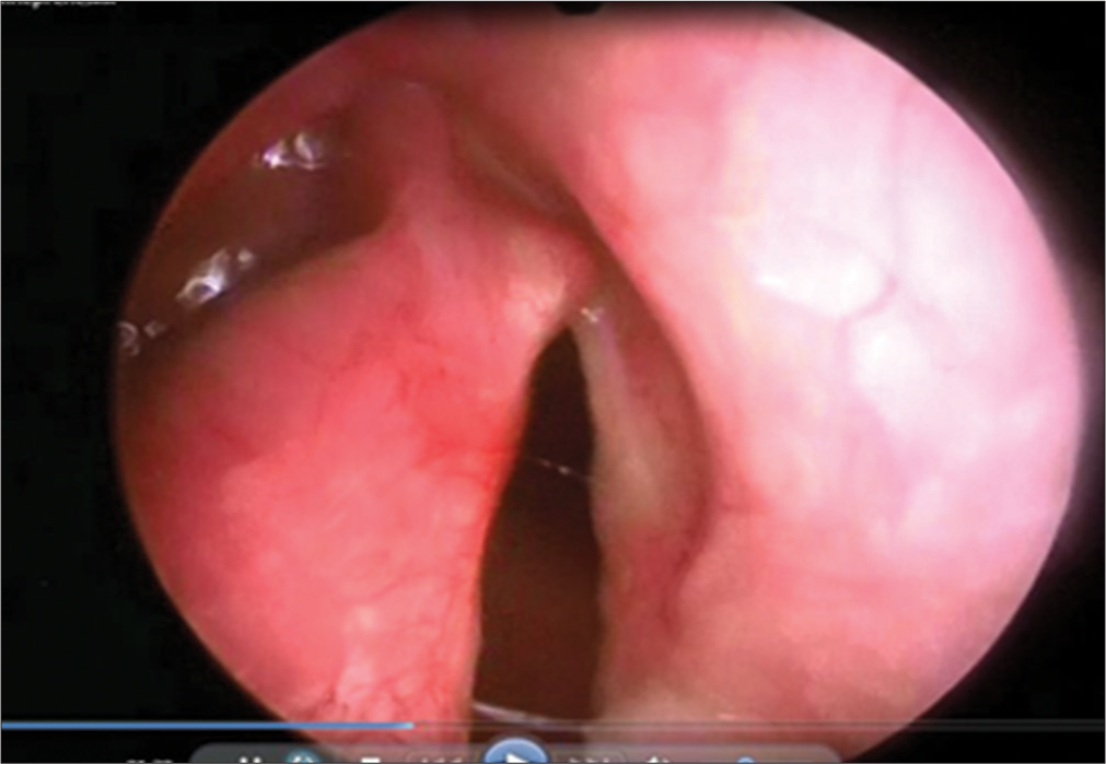 Fibrogastroduodenoscopy: Laryngeal cleft of the 3rd degree.