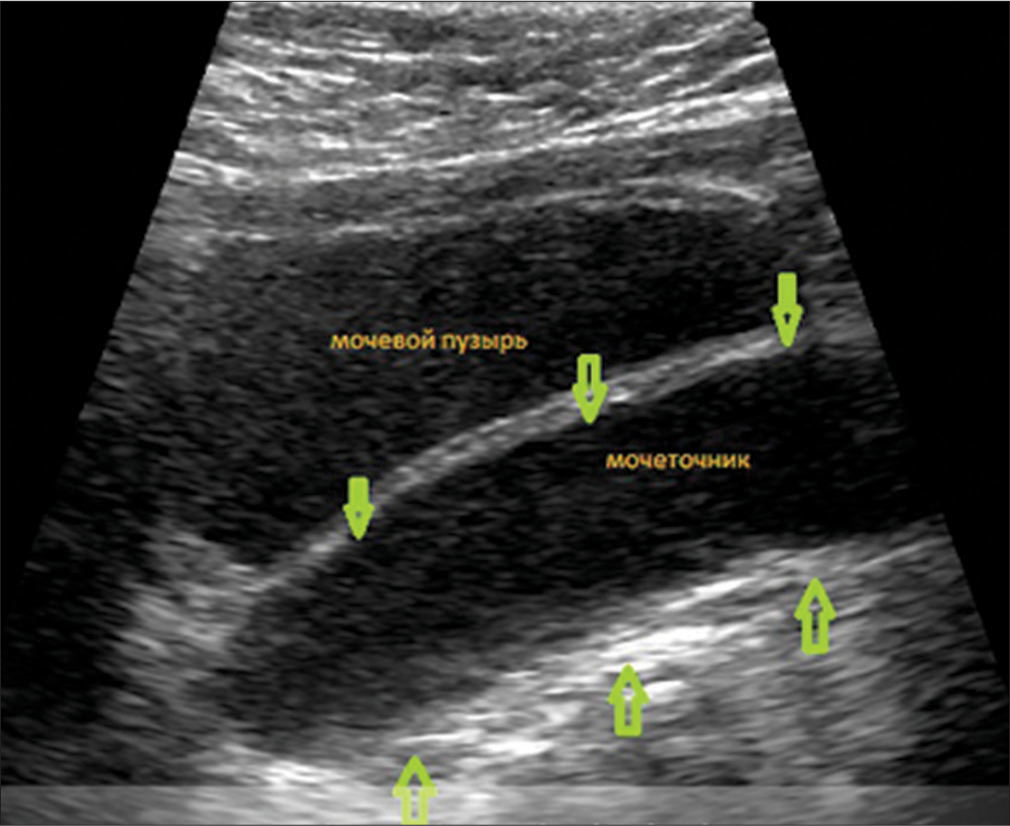 Ultrasound of the kidneys and bladder: Signs of a megaureter on the left, thickening of the walls of the ureter. The green arrows indicate the thickened walls of the ureter.