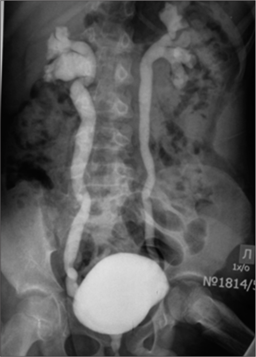 Mictional cystogram: A picture of bilateral vesicoureteral reflux of II and III degrees, megaureter.