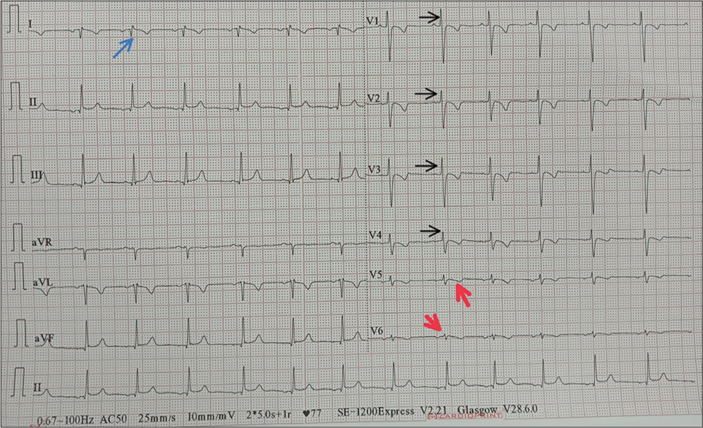 Electrocardiogram showing right axis deviation, inversion of all complexes in lead I (inverted P wave, negative QRS, inverted T wave) shown as blue arrow, an absent R wave progression and prominence of S wave in the anterior leads (shown as black arrow) and low voltage in leads V4–V6 (shown as red arrow).