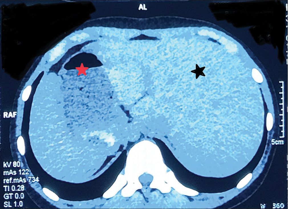 High-resolution computed tomography showing liver on the left (black star) and stomach bubble on the right side (red star).