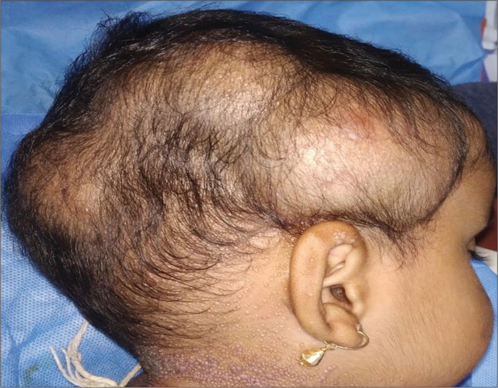 Multiple, large, firm, skin-coloured and non-tender tumours involving the scalp.