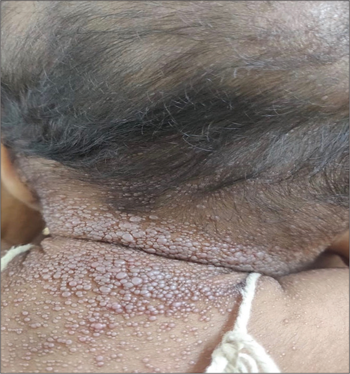 Innumerable, grouped, pink to skin-coloured, smooth, flat to dome-shaped papules over the neck, scalp and ears.