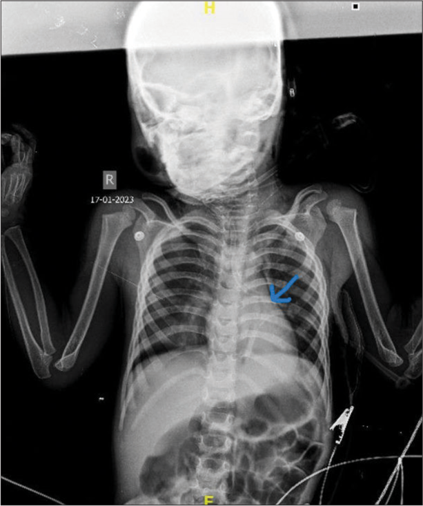 X-ray showing broken tracheostomy tube in the left main bronchus (Blue arrow).