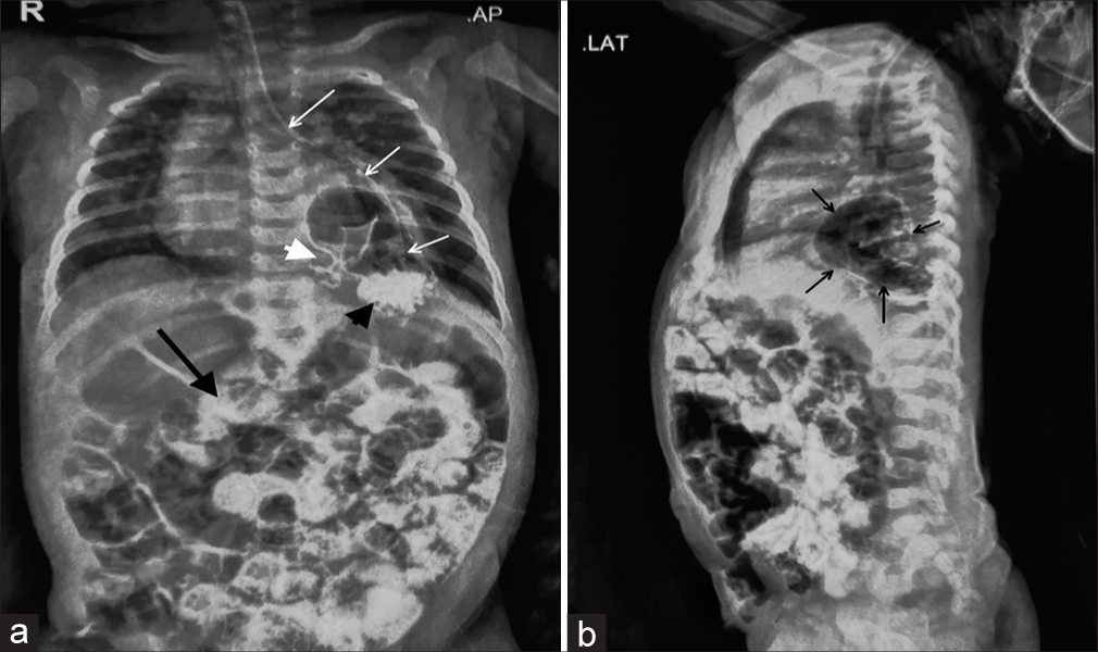 (a) A chest X-ray AP view post-contrast. Stomach bubble is absent in the abdomen. White arrows trace the orogastric tube, which ends in the left thorax. Contrast delineates the anatomy of the stomach, which is present in the thorax. The black arrowhead points to the contrast material in the stomach fungus. White arrowhead points to the pylorus of the stomach. Contrast can also be seen in the intestine (black arrow). (b) A chest X-ray lateral view post-contrast. The black arrow points to the stomach, which is posterior to the heart shadow. Contrast can also be seen in the intestine.