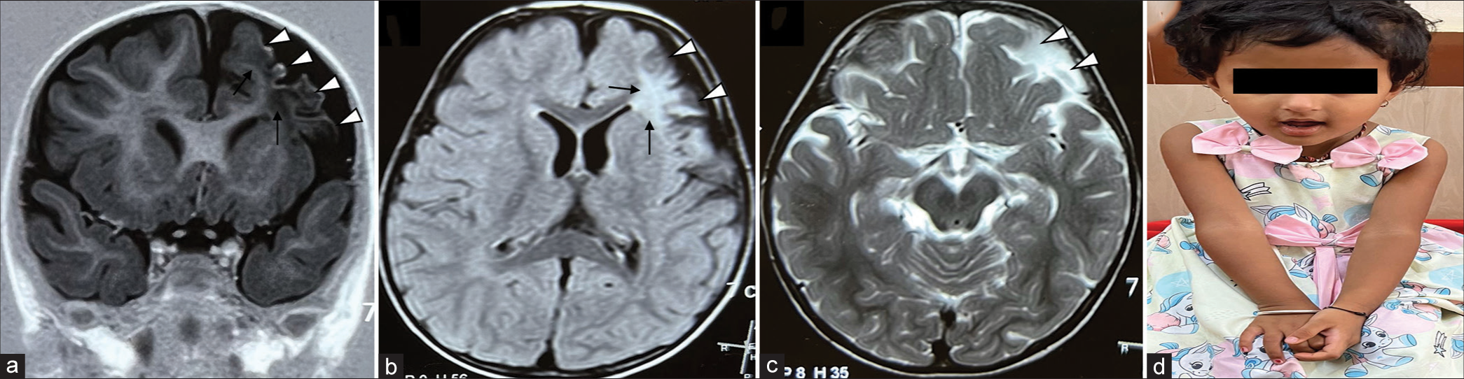 (a) Magnetic resonance imaging brain with T1-weighted coronal (white arrow heads), (b) T2-weighted axial (white arrow heads) and (c) short tau inversion recovery axial sequences show loss of left frontal lobe volume (white arrow heads) with gliotic ischaemic areas (thin black arrows) in cortex and subcortical white matter regions, (d) Clinical photograph of the child during the last follow-up at three years showing mild residual weakness of the right upper limb.