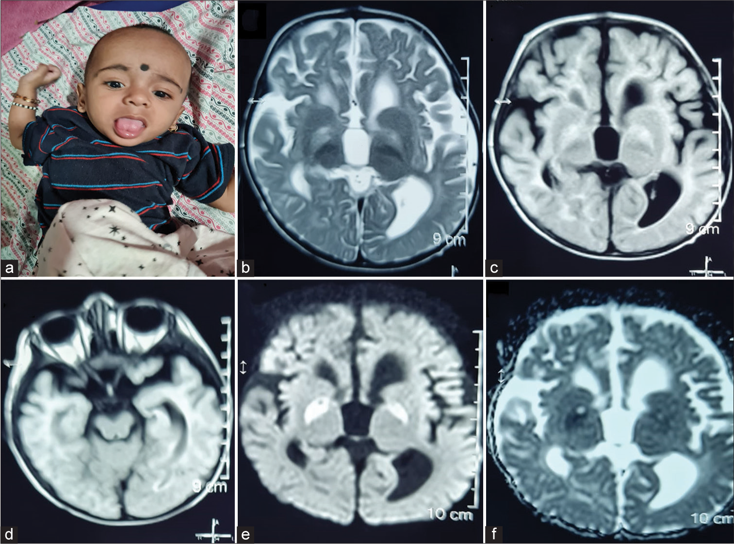 (a) Clinical photograph of the child showing tongue and upper limb dystonia, (b) axial T2-weighted (Two headed arrow), (c) fluid-attenuated inversion recovery sequences of magnetic resonance imaging of brain images showing bilateral symmetrical globus pallidus hyperintensity, bilateral basal ganglia atrophy, predominantly involving globus pallidus (left more than right) (Two headed arrow), (d) cerebral peduncles appear normal (Two headed arrow), (e) axial diffusion weighted images (DWIs) (Two headed arrow) show restriction of diffusion in bilateral globus pallidus, with hyperintensity on DWI images and (f) hypointensity of corresponding apparent diffusion coefficient maps (Two headed arrow).