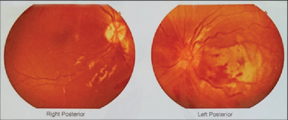 Fundus Right eye: Normal, Left eye: tortuous blood vessels, hemorrhages around the disc, macular edema, cherry red spots, optic neuritis with retinitis with sub-foveal serous fluid.