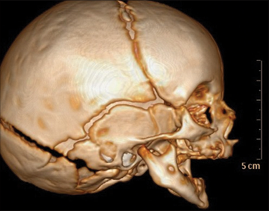 The computed tomography scan of head and neck showing small and retro mandible before the device placement.