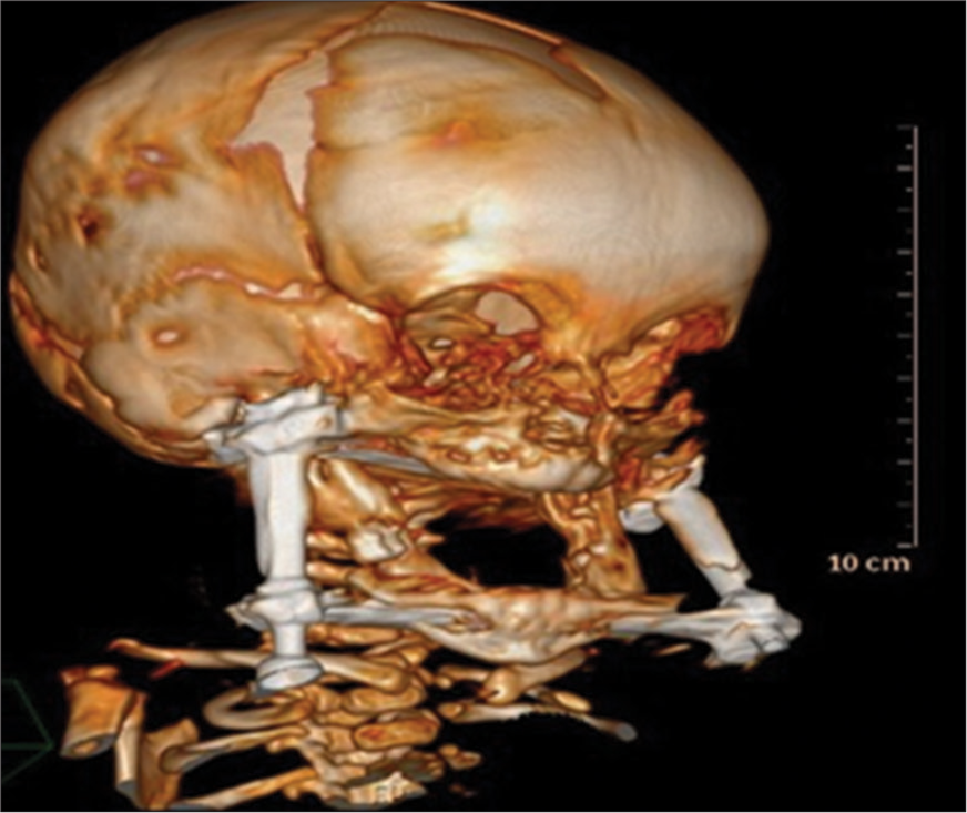 Computed tomography scan of head and neck showing the lengthening of mandible after a period of device placement.