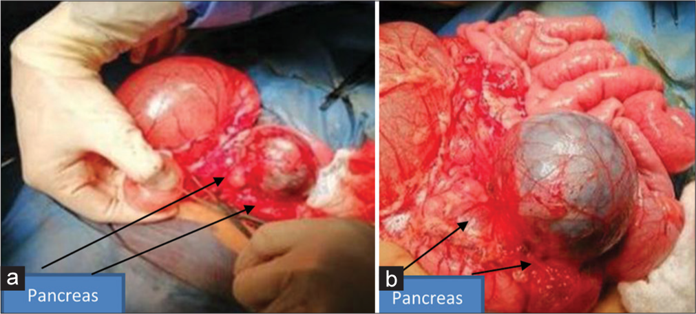 (a and b) Operative picture shows the pancreas with multiple pancreatic cysts.