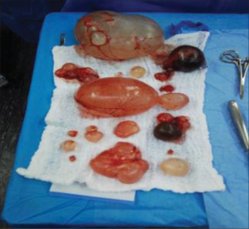 Post-operative pancreatic cysts after excision with variable sizes.