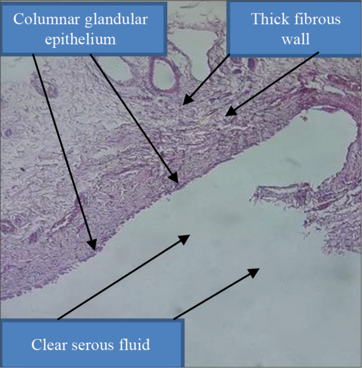 Histopathological finding of pancreatic cyst.