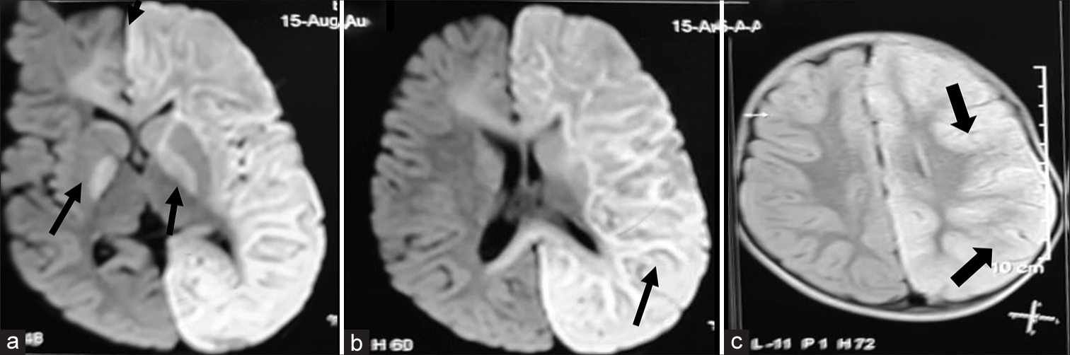 (a and b) Magnetic resonance imaging brain shows diffuse oedema of the left hemisphere, corpus callosum, left internal capsule and bilateral globus pallidus regions appearing hyperintense (black arrows) on axial diffusion-weighted imaging and hyperintense (black arrows) on fluid-attenuated inversion recovery (c) sequences on 7th day at 13 months of age when admitted to the hospital (black arrows).