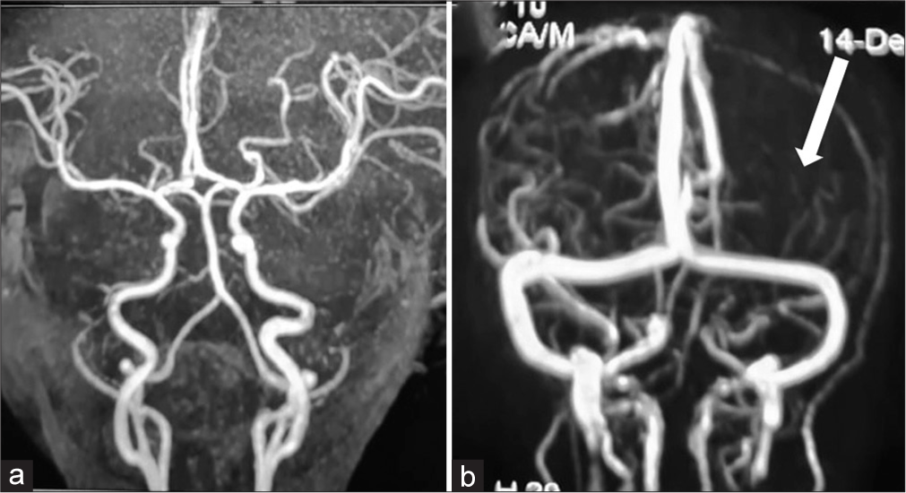 Magnetic resonance angiography (a) shows no obstruction or narrowing of vessels. Magnetic resonance venogram (b) shows reduced number of vessels and flow in the left cerebral hemisphere (thick white arrow) on the 7th day at 13 months of age when admitted to the hospital.